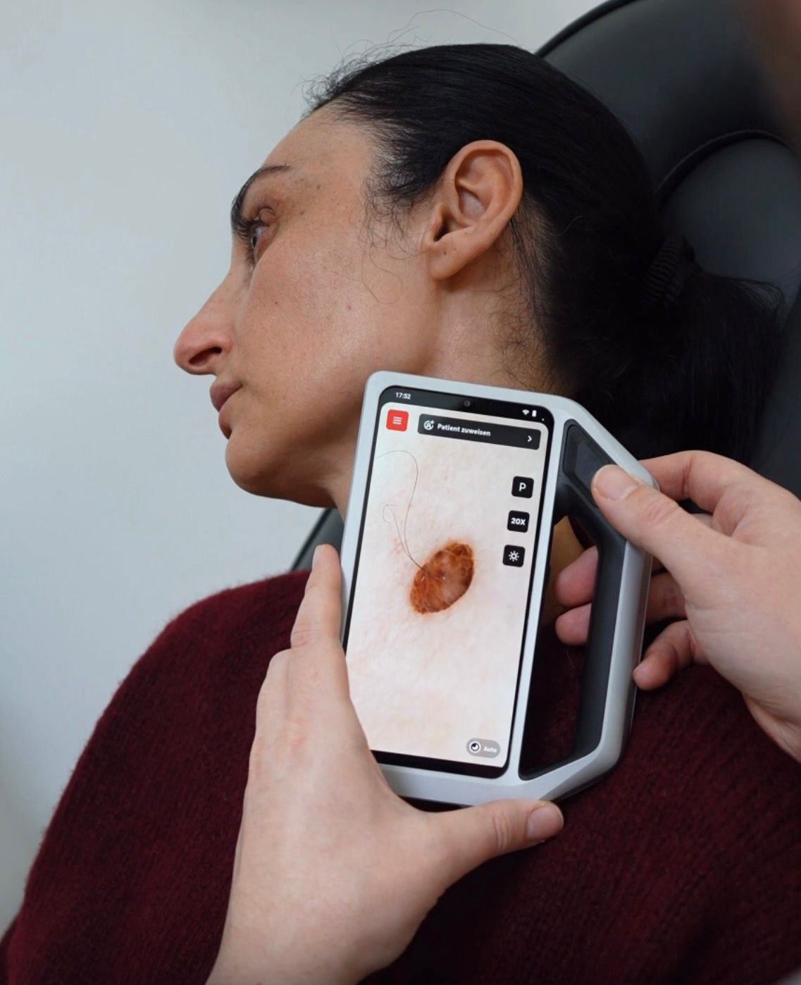 Dermatoskop Untersuchung für Muttermal- und Hautscreenings